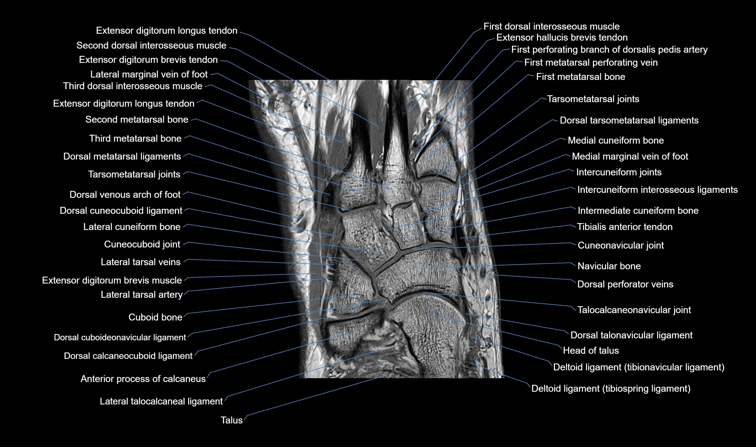 MRI mid foot coronal ligaments cross sectional anatomy 3T  radiology  image-img-00001-00018.webp